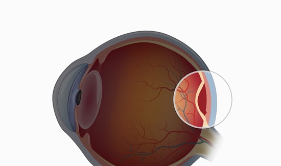 جداشدگی شبکیه و روش های درمان آن 